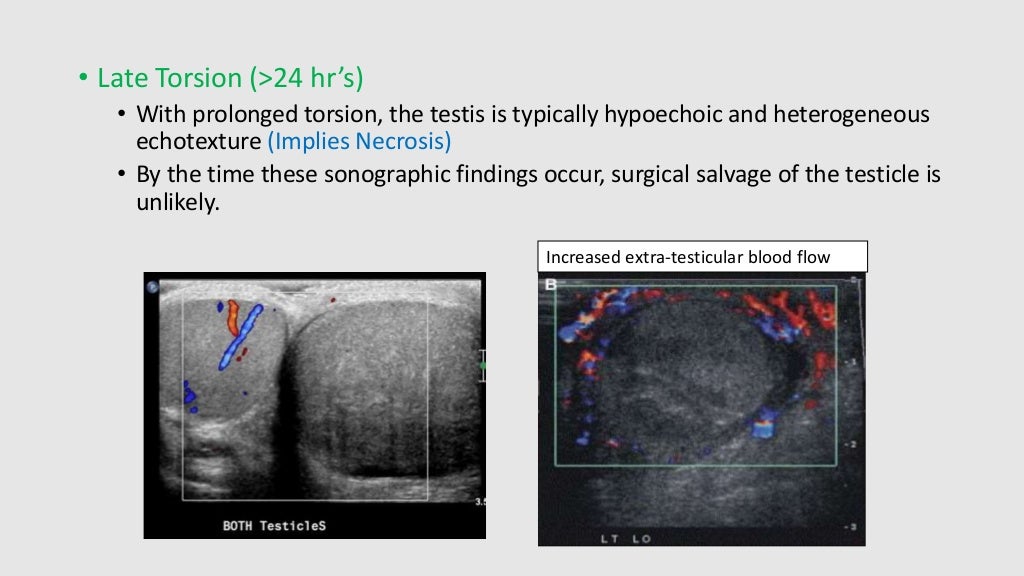 Testicular Torsion Pediatrics Surgery