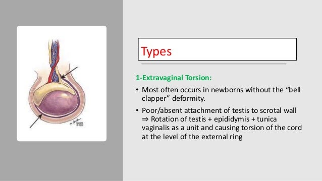 Testicular Torsion - Pediatrics Surgery