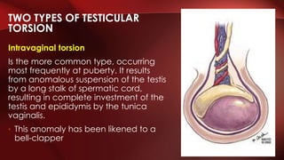 Intravaginal torsion
Is the more common type, occurring
most frequently at puberty. It results
from anomalous suspension of the testis
by a long stalk of spermatic cord,
resulting in complete investment of the
testis and epididymis by the tunica
vaginalis.
• This anomaly has been likened to a
bell-clapper
TWO TYPES OF TESTICULAR
TORSION
 