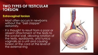 Extravaginal torsion
• Most often occurs in newborns
without the “bell clapper”
deformity.
• It is thought to result from a poor or
absent attachment of the testis to
the scrotal wall, allowing rotation of
the testis, epididymis, and tunica
vaginalis as a unit and causing
torsion of the cord at the level of
the external ring
TWO TYPES OF TESTICULAR
TORSION
 