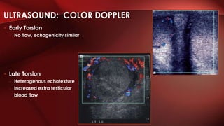 ULTRASOUND: COLOR DOPPLER
• Early Torsion
– No flow, echogenicity similar
• Late Torsion
– Heterogenous echotexture
– Increased extra testicular
blood flow
 