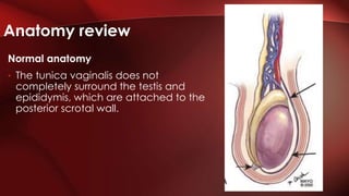 Normal anatomy
• The tunica vaginalis does not
completely surround the testis and
epididymis, which are attached to the
posterior scrotal wall.
Anatomy review
 