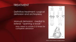 TREATMENT
• Definitive treatment: surgical
detorsion and orchioplexy
• Manual detorsion: medial to
lateral; “opening a book”
– May need to rotate 2-3 times for
complete detorsion
Roberts: Clinical Procedures in Emergency Medicine
 