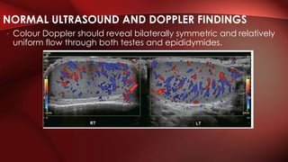 • Colour Doppler should reveal bilaterally symmetric and relatively
uniform flow through both testes and epididymides.
NORMAL ULTRASOUND AND DOPPLER FINDINGS
 