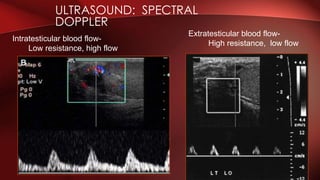 ULTRASOUND: SPECTRAL
DOPPLER
Extratesticular blood flow-
High resistance, low flow
Intratesticular blood flow-
Low resistance, high flow
 