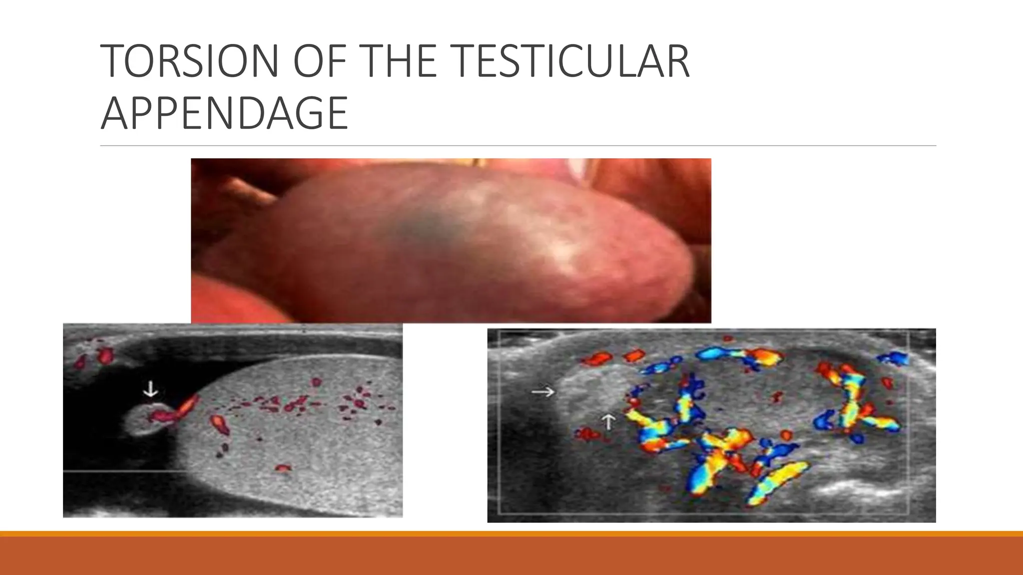 Testicular Torsion Surgical Emergency pptx