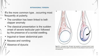 Testicular torsion and Epididymo-orchitis.pptx