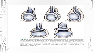 Orchitis Ct Testicular torsion and Epididymo-orchitis.pptx
