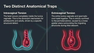 Testicular Torsion (Time is tissue).pptx