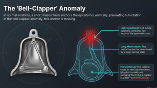 Testicular Torsion (Time is tissue).pptx