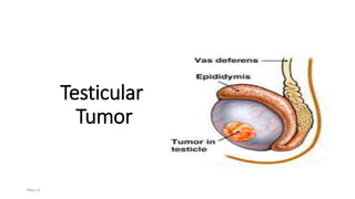 Testicular
Tumor
May 13
 