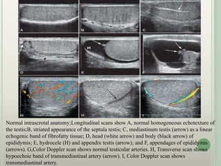 Normal intrascrotal anatomy;Longitudinal scans show A, normal homogeneous echotexture of
the testis;B, striated appearance of the septula testis; C, mediastinum testis (arrow) as a linear
echogenic band of fibrofatty tissue; D, head (white arrow) and body (black arrow) of
epididymis; E, hydrocele (H) and appendix testis (arrow); and F, appendages of epididymis
(arrows). G,Color Doppler scan shows normal testicular arteries. H, Transverse scan shows
hypoechoic band of transmediastinal artery (arrow). I, Color Doppler scan shows
transmediastinal artery.
 