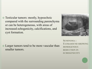 SEMINOMA :
ULTRASOUND SHOWING
HOMOGENOUS
REDUCTION IN
ECHOGENECITY
 Testicular tumors: mostly, hypoechoic
compared with the surrounding parenchyma
or can be heterogeneous, with areas of
increased echogenicity, calcifications, and
cyst formation.
 Larger tumors tend to be more vascular than
smaller tumors.
 