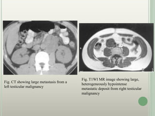 Fig. CT showing large metastasis from a
left testicular malignancy
Fig. T1WI MR image showing large,
heterogeneously hypointense
metastatic deposit from right testicular
malignancy
 