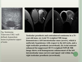 Fig. Seminoma
Transverse USG: well-
defined, hypoechoic
lesion in posterior aspect
of testis
Testicular prosthesis and contralateral seminoma in a 31-
year-old man. (a) Axial T2-weighted MR image
demonstrates a left intratesticular mass (arrow), which is
uniformly hypointense with respect to the left testis, and a
right testicular prosthesis (arrowhead). (b) Axial contrast-
enhanced fat-suppressed 3D T1-weighted FSPGR MR
image shows avid homogeneous enhancement of the left
intratesticular mass (arrow) and signal void within the
right testicular prosthesis (arrowhead).
 