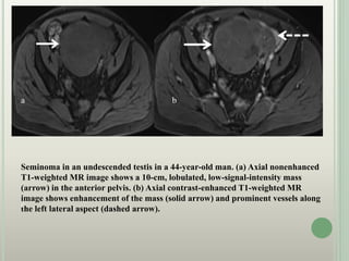 Seminoma in an undescended testis in a 44-year-old man. (a) Axial nonenhanced
T1-weighted MR image shows a 10-cm, lobulated, low-signal-intensity mass
(arrow) in the anterior pelvis. (b) Axial contrast-enhanced T1-weighted MR
image shows enhancement of the mass (solid arrow) and prominent vessels along
the left lateral aspect (dashed arrow).
a b
c
 