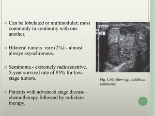  Can be lobulated or multinodular; most
commonly in continuity with one
another.
 Bilateral tumors: rare (2%) - almost
always asynchronous.
 Seminoma - extremely radiosensitive.
5-year survival rate of 95% for low-
stage tumors.
 Patients with advanced stage disease –
chemotherapy followed by radiation
therapy.
Fig. USG showing multifocal
seminoma
 