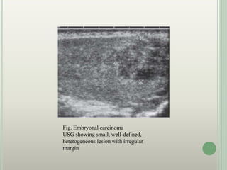 Fig. Embryonal carcinoma
USG showing small, well-defined,
heterogeneous lesion with irregular
margin
 
