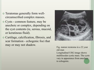  Teratomas generally form well-
circumscribed complex masses.
 Cysts - common feature, may be
anechoic or complex, depending on
the cyst contents (ie, serous, mucoid,
or keratinous fluid).
 Cartilage, calcification, fibrosis, and
scar formation - echogenic foci that
may or may not shadow.
Fig. mature teratoma in a 22 year
old man
Longitudinal USG image shows
multilocular cystic mass. The cysts
vary in appearance from anechoic
to echogenic.
 