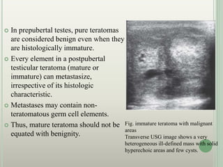  In prepubertal testes, pure teratomas
are considered benign even when they
are histologically immature.
 Every element in a postpubertal
testicular teratoma (mature or
immature) can metastasize,
irrespective of its histologic
characteristic.
 Metastases may contain non-
teratomatous germ cell elements.
 Thus, mature teratoma should not be
equated with benignity.
Fig. immature teratoma with malignant
areas
Transverse USG image shows a very
heterogeneous ill-defined mass with solid
hyperechoic areas and few cysts.
 