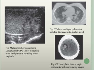 Fig. Metastatic choriocarcinoma
Longitudinal USG shows isoechoic
mass in right testis invading tunica
vaginalis
Fig. CT chest: multiple pulmonary
nodules. Gynecomastia is also noted
Fig. CT head plain: hemorrhagic
metastasis with surrounding edema
 