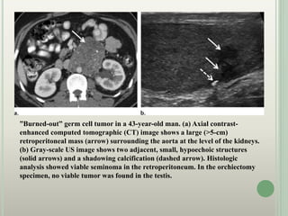 ”Burned-out” germ cell tumor in a 43-year-old man. (a) Axial contrast-
enhanced computed tomographic (CT) image shows a large (>5-cm)
retroperitoneal mass (arrow) surrounding the aorta at the level of the kidneys.
(b) Gray-scale US image shows two adjacent, small, hypoechoic structures
(solid arrows) and a shadowing calcification (dashed arrow). Histologic
analysis showed viable seminoma in the retroperitoneum. In the orchiectomy
specimen, no viable tumor was found in the testis.
 