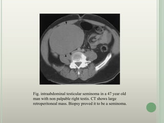 Fig. intraabdominal testicular seminoma in a 47 year old
man with non palpable right testis. CT shows large
retroperitoneal mass. Biopsy proved it to be a seminoma.
 