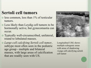 Sertoli cell tumors
 less common, less than 1% of testicular
tumors.
 Less likely than Leydig cell tumors to be
hormonally active, but gynecomastia can
occur.
 Typically well-circumscribed, unilateral,
round to lobulated masses.
 Large-cell calcifying Sertoli cell tumor,
subtype most often seen in the pediatric
age group - multiple and bilateral
masses, with large areas of calcification
that are readily seen with US.
Longitudinal USG shows
multiple echogenic areas
with areas of shadowing
-Large cell calcifying sertoli
cell tumor
 