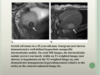 Sertoli cell tumor in a 45-year-old man. Sonogram (not shown)
demonstrated a well-defined hypoechoic nonspecific
intratesticular nodule. On axial MR images, the intratesticular
nodule (arrow) was barely visible on T1-weighted images (not
shown), is hypointense on the T2-weighted image (a), and
demonstrates homogeneous hyperenhancement (relative to the
testis) on the contrast-enhanced image (b).
 
