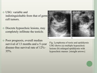  USG: variable and
indistinguishable from that of germ
cell tumors.
 Discrete hypoechoic lesions, may
completely infiltrate the testicle.
 Poor prognosis, overall median
survival of 13 months and a 5-year
disease-free survival rate of 12%–
35%.
Fig. Lymphoma of testis and epididymis
USG shows (a) multiple hypoechoic
lesions (b) enlarged epididymis with
hypoechoic masses {straight arrows}
 