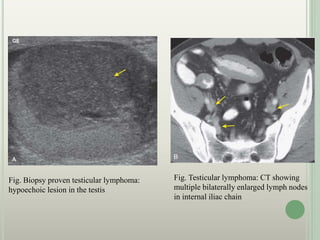 Fig. Biopsy proven testicular lymphoma:
hypoechoic lesion in the testis
Fig. Testicular lymphoma: CT showing
multiple bilaterally enlarged lymph nodes
in internal iliac chain
 