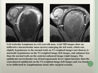 Left testicular lymphoma in a 62-year-old man. Axial MR images show an
infiltrative intratesticular mass (arrow) enlarging the left testis, which was
slightly hypointense to the normal testis on T1-weighted images (not shown), is
markedly hypointense on the T2-weighted image (left image), and enhances less
than the normal testis on the contrast-enhanced image (right image). The
epididymis (arrowheads) was of heterogeneously lower signal intensity than the
contralateral epididymis on the T2-weighted image (left image) and was found
to be infiltrated by lymphomatous tissue after surgical excision.
 