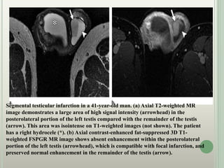 Segmental testicular infarction in a 41-year-old man. (a) Axial T2-weighted MR
image demonstrates a large area of high signal intensity (arrowhead) in the
posterolateral portion of the left testis compared with the remainder of the testis
(arrow). This area was isointense on T1-weighted images (not shown). The patient
has a right hydrocele (*). (b) Axial contrast-enhanced fat-suppressed 3D T1-
weighted FSPGR MR image shows absent enhancement within the posterolateral
portion of the left testis (arrowhead), which is compatible with focal infarction, and
preserved normal enhancement in the remainder of the testis (arrow).
 