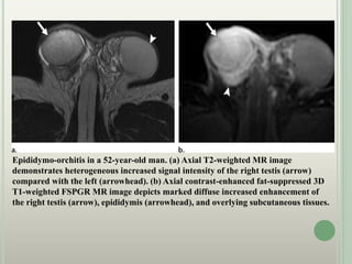 Epididymo-orchitis in a 52-year-old man. (a) Axial T2-weighted MR image
demonstrates heterogeneous increased signal intensity of the right testis (arrow)
compared with the left (arrowhead). (b) Axial contrast-enhanced fat-suppressed 3D
T1-weighted FSPGR MR image depicts marked diffuse increased enhancement of
the right testis (arrow), epididymis (arrowhead), and overlying subcutaneous tissues.
 