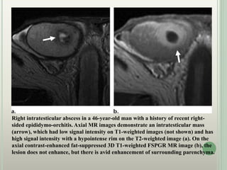Right intratesticular abscess in a 46-year-old man with a history of recent right-
sided epididymo-orchitis. Axial MR images demonstrate an intratesticular mass
(arrow), which had low signal intensity on T1-weighted images (not shown) and has
high signal intensity with a hypointense rim on the T2-weighted image (a). On the
axial contrast-enhanced fat-suppressed 3D T1-weighted FSPGR MR image (b), the
lesion does not enhance, but there is avid enhancement of surrounding parenchyma.
 
