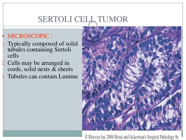 Leydig cell cancer