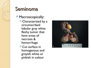 SeminomaSeminoma
Macroscopically:
Characterized by a
circumscribed
lobular gray white
fleshy tumor that
have areas of
necrosis &
hemorrhage
Cut surface in
homogenous and
greyish white or
pinkish in colour
 