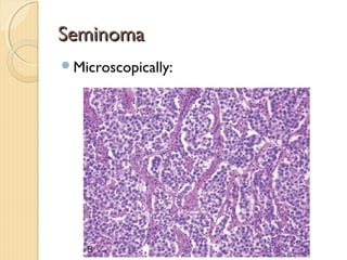 SeminomaSeminoma
Microscopically:
 