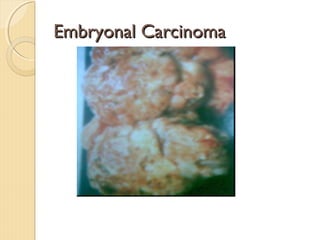 Embryonal CarcinomaEmbryonal Carcinoma
 