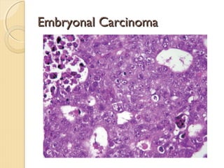 Embryonal CarcinomaEmbryonal Carcinoma
 