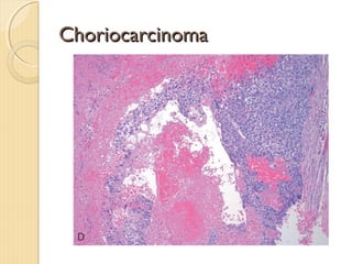 ChoriocarcinomaChoriocarcinoma
 
