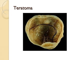 TeratomaTeratoma
 