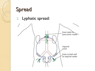 SpreadSpread
2. Lyphatic spread:
 