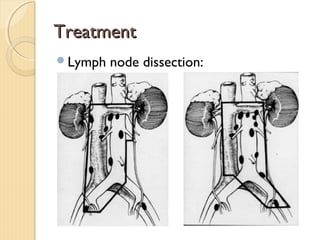 TreatmentTreatment
Lymph node dissection:
 