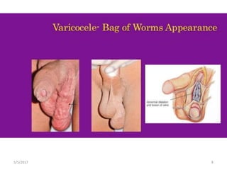 What are the Causes of Varicocele? | NOVA IVF