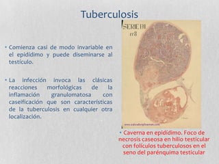 Torsión testicular
Neonatal
Se produce en el
útero materno o
poco después del
nacimiento
Adulto
(adolescencia)
Se manifies...