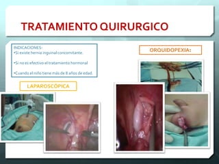 INDICACIONES:
•Si existe hernia inguinal concomitante.
•Si no es efectivo el tratamiento hormonal
•Cuando el niño tiene más de 8 años de edad.
ORQUIDOPEXIA:
LAPAROSCÓPICA
TRATAMIENTO QUIRURGICO
 