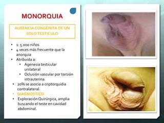 MONORQUIA
AUSENCIA CONGÉNITA DE UN
SOLOTESTICULO
• 1: 5.000 niños
• 4 veces más frecuente que la
anorquia
• Atribuida a:
• Agenesia testicular
unilateral
• Oclusión vascular por torsión
intrauterina.
• 20% se asocia a criptorquidia
contralateral.
• DIAGNOSTICO
• Exploración Quirúrgica, amplia
buscando el teste en cavidad
abdominal.
 