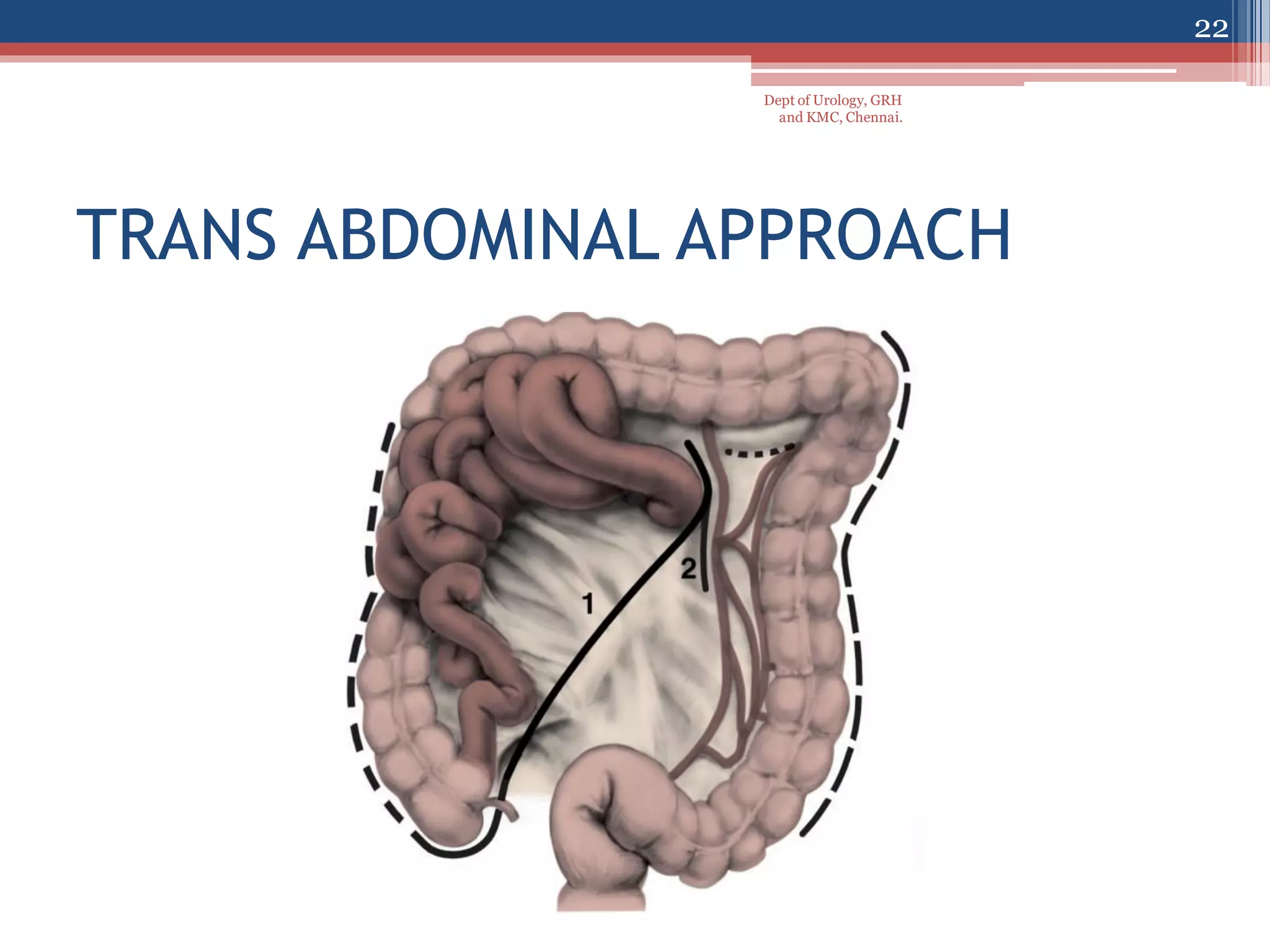 Open Rplnd Testis carcinoma- management- lymphatic drainage and rplnd | PDF