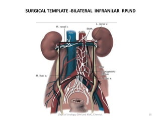 SURGICAL TEMPLATE -BILATERAL INFRANILAR RPLND
10
Dept of Urology, GRH and KMC, Chennai.
 